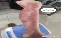【皮膚科普知識】何為丹毒？如何解毒？帶您了解
